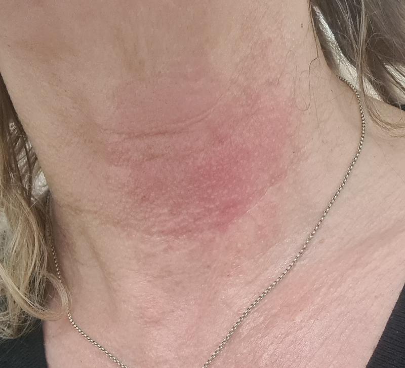 Sore and worse than sunburn