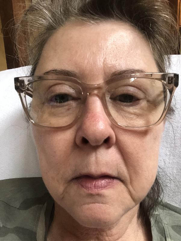 My forehead broke out, first time since pre Erno(43 years ago)