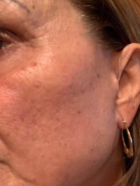 Customer photo for "Skin Resurfacing in a Bottle"