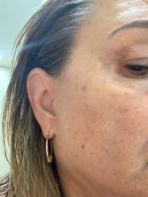 Customer photo for "Skin Resurfacing in a Bottle"