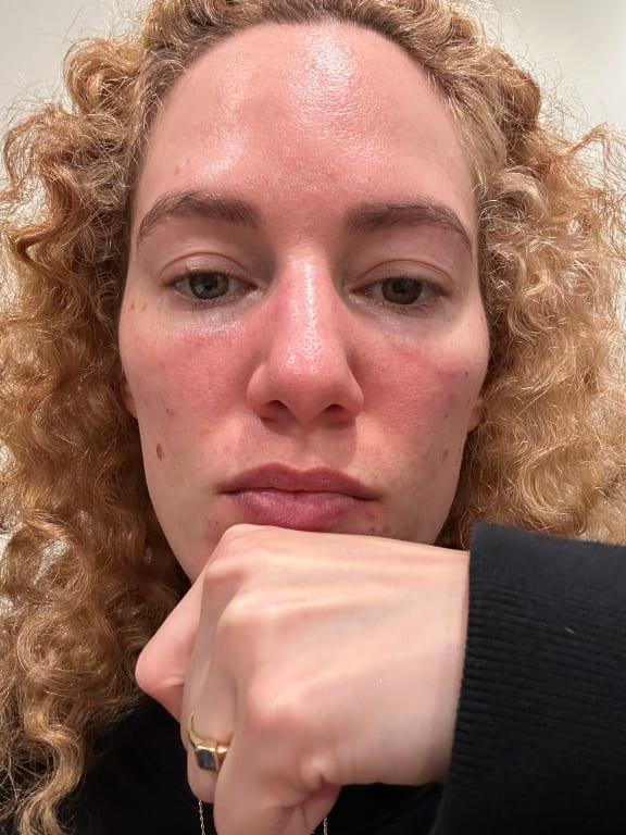 Face very burned