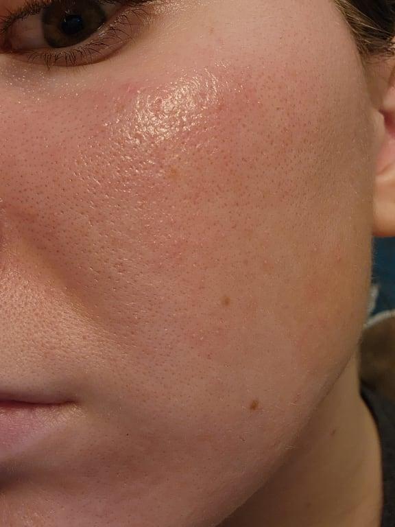 This is the rash after healing for 2 days