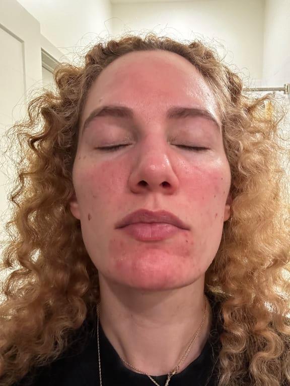 Face irritated and burned