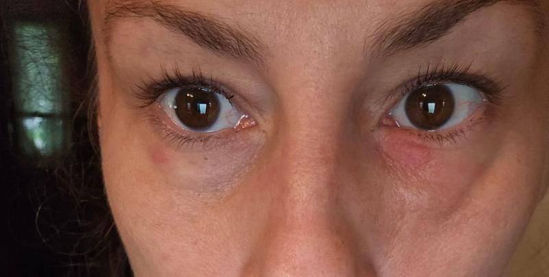 Under eye is blown upand deflated like a saggy balloon