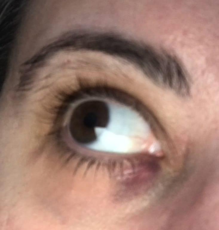 image of bruise and discoloration