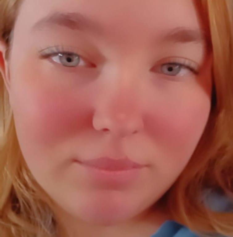 Redness is normal, had it before starting the moisturizer