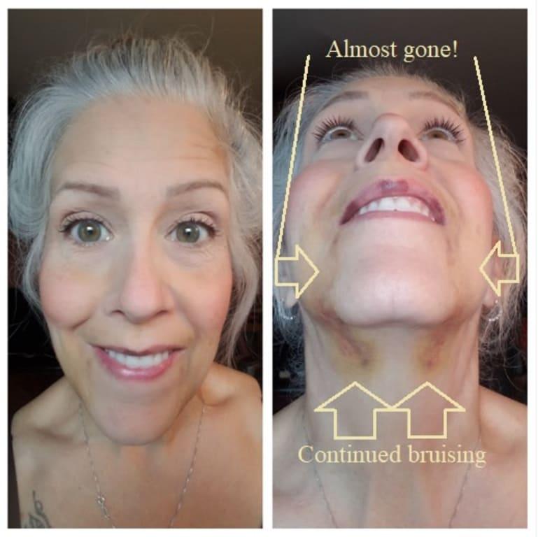 Progress of cream (day) & serum (night) use