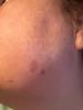 Dark spots