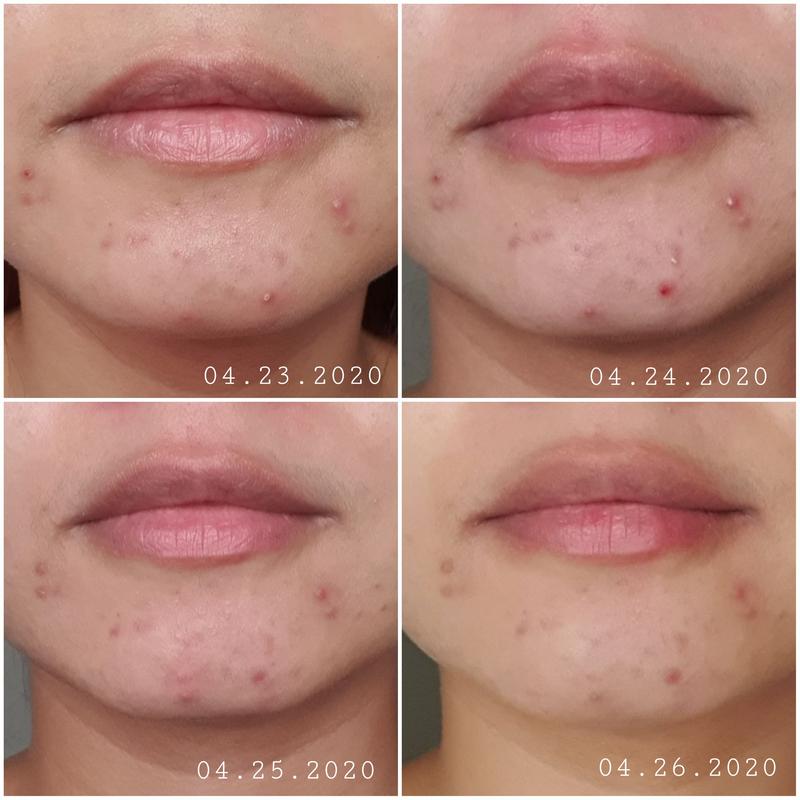 Daily photos of my cystic acne flattened in 4 days. @pastelscales
