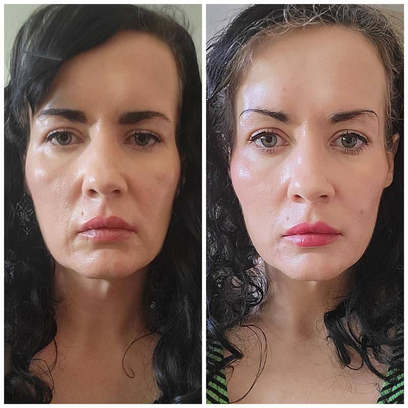 One year apart after using Bear Mini