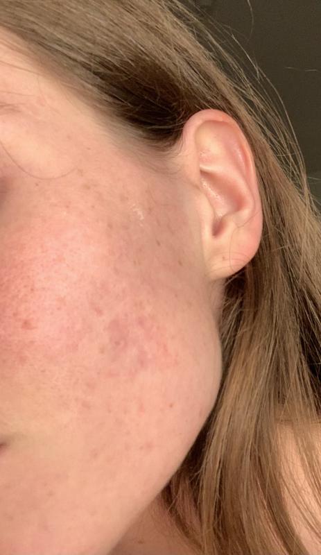 Beaucoup moins de boutons et mes cicatrices estompées