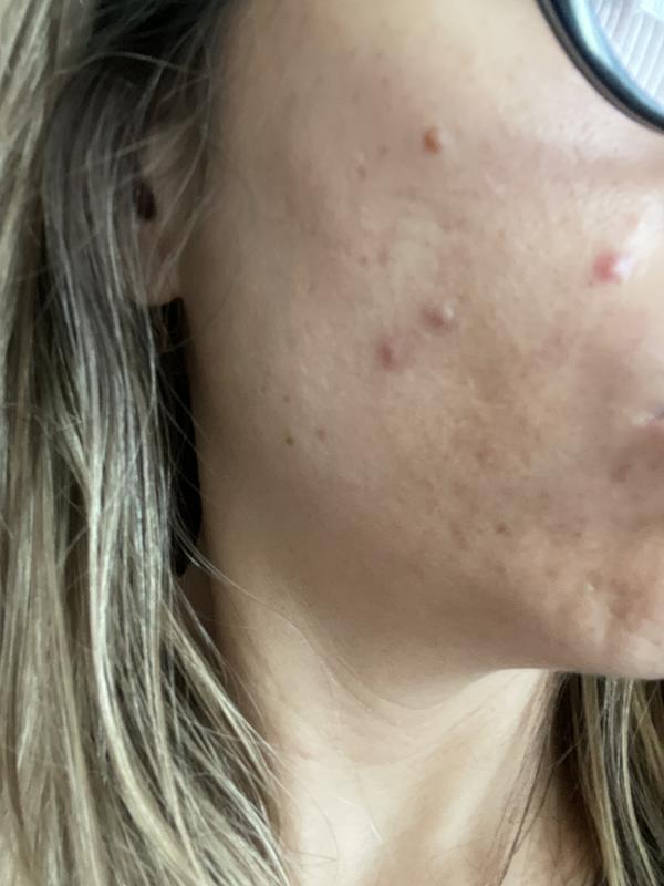 My breakouts still the same