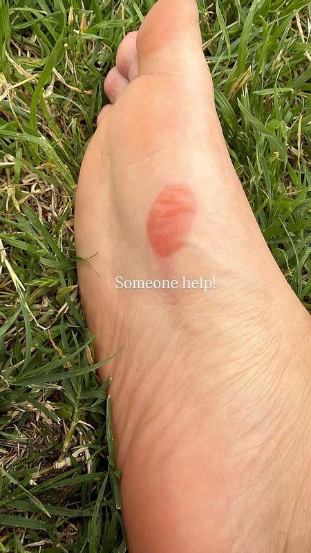 Customer photo for "Got blisters"