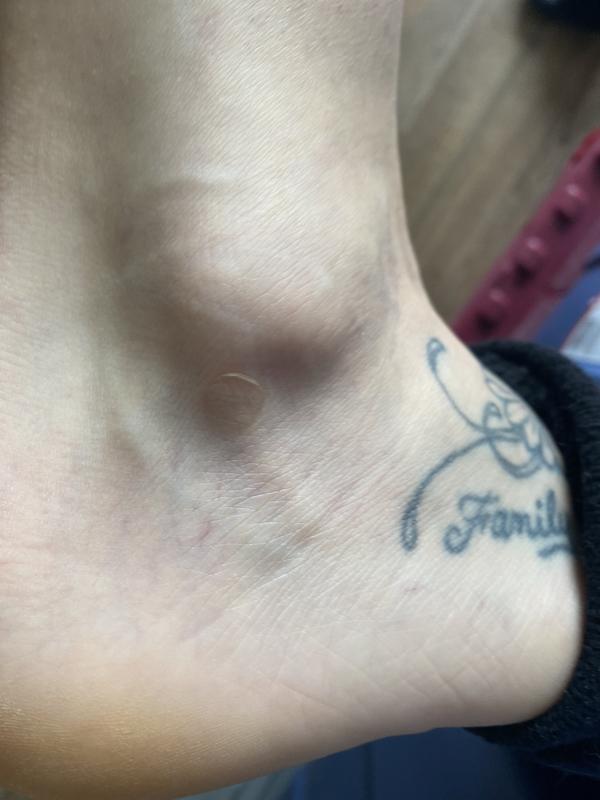 Plastic digs inward towards ankle causing friction while walking: resulting in a blister.