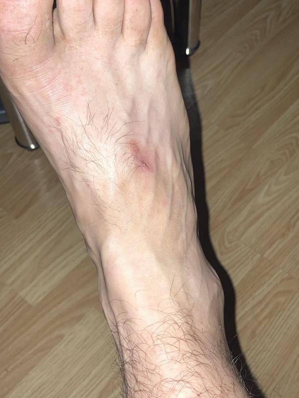 cut healing after not wearing them for a week!!