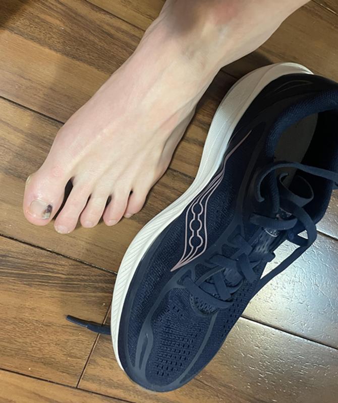 My toe is still bruised after a month.