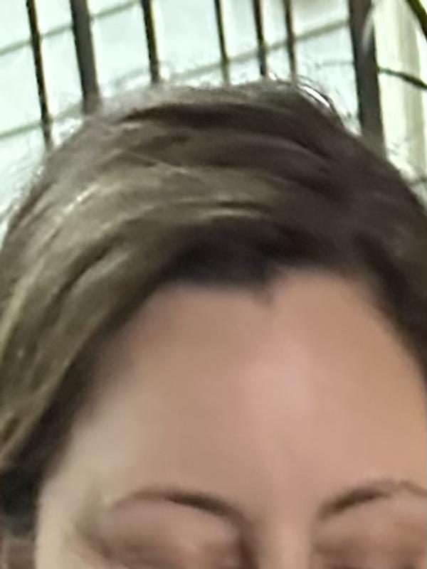 State of my forehead prior to using this product. Despite stopping it immediately and making no other changes to my regime or nutrition I have not been able to get Reid of the texture change on my foreheads which is redness and red bumps.