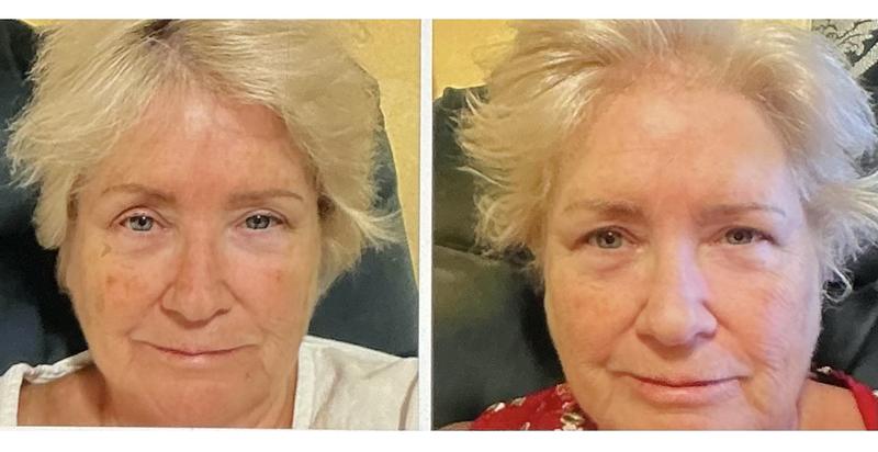 Works great on age spots