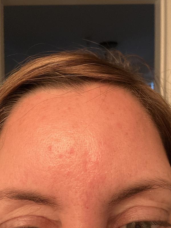 Current skin on forehead 18 months after using this product for a week