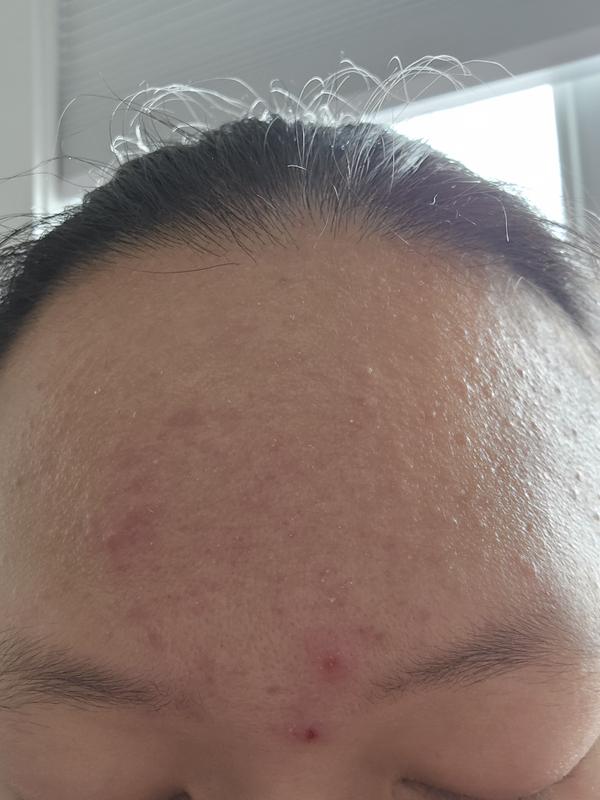 Customer photo for "New formula causing skin issues"