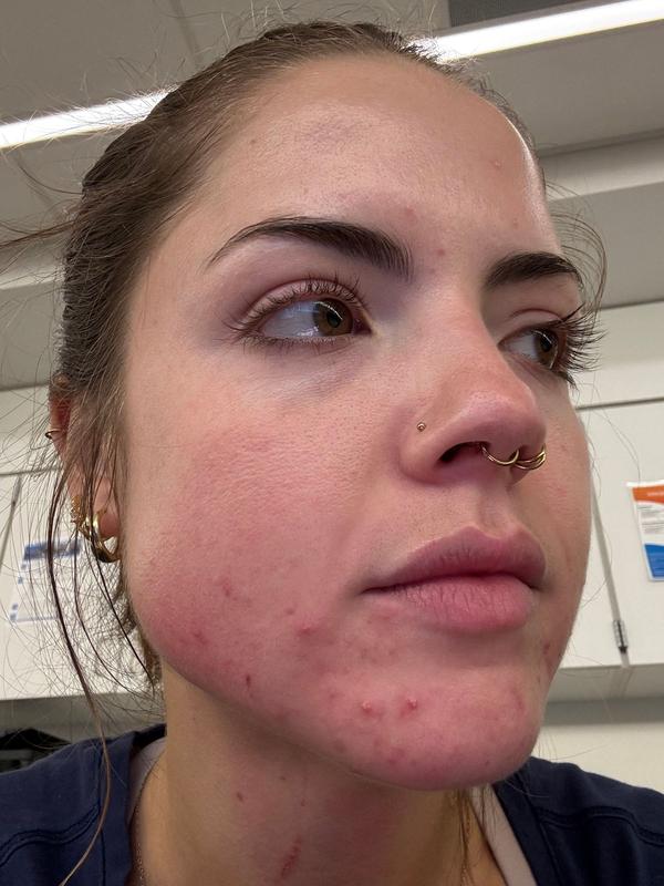 Customer photo for "Acne nightmare"