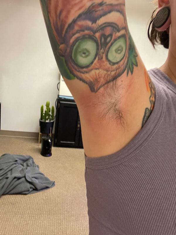 Customer photo for "Severely burned my armpit skin"