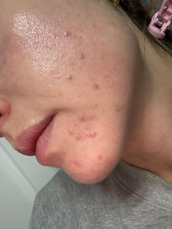 Customer photo for "Acne nightmare"