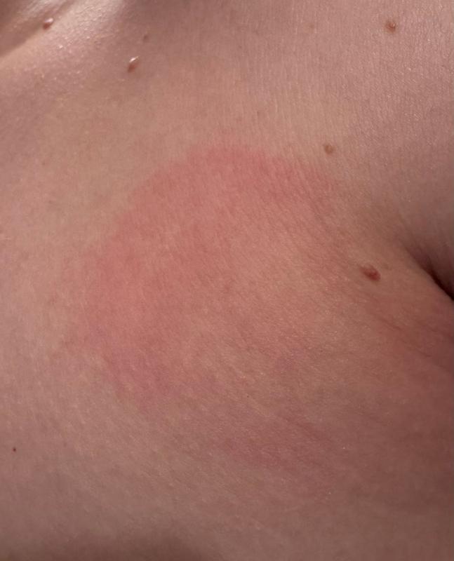 Customer photo for "Rash"