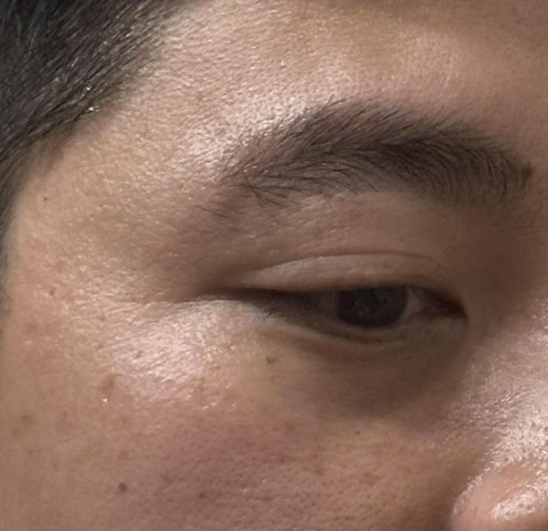 MY EYE WRINKLES HAVE GONE