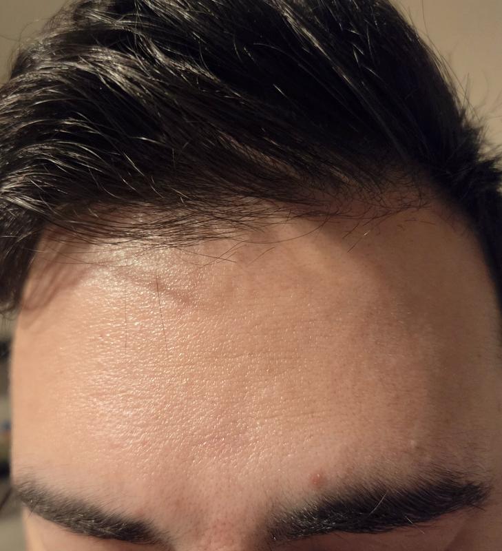 Customer photo for "Preventative treatment for new fine lines"