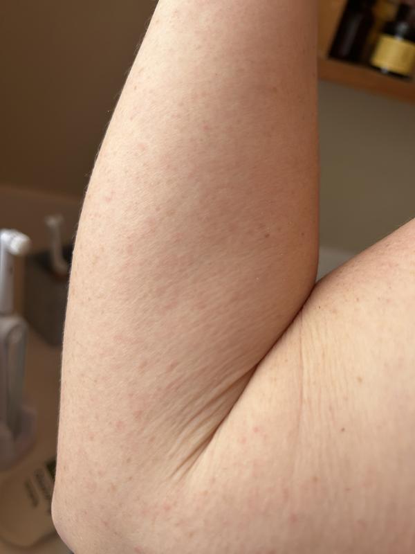 Fine, itchy rash all over arms and legs after using