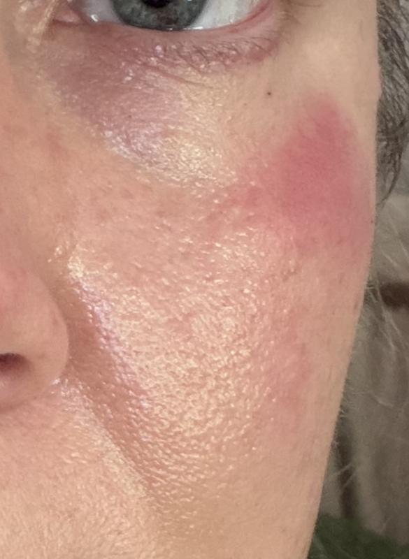 Burn marks after using product on under eye