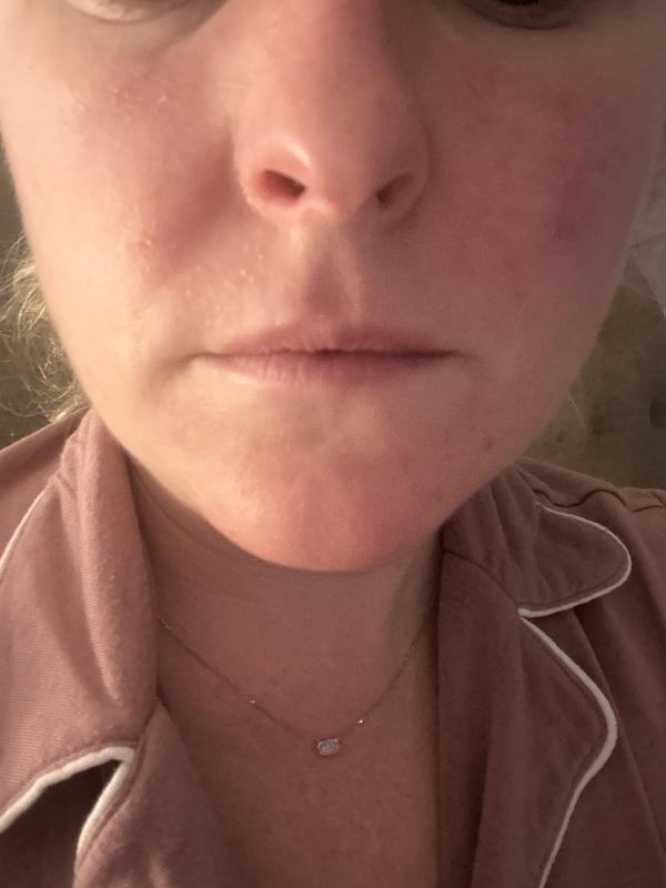 Very dry and rash
