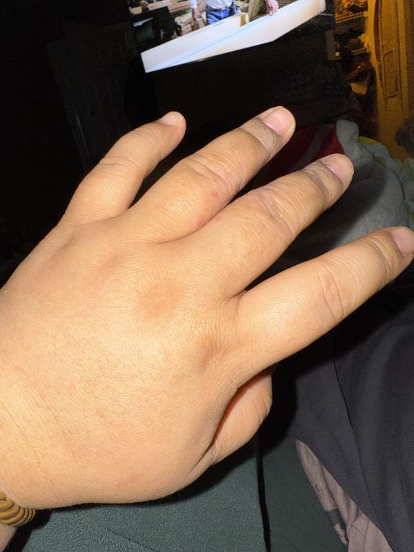 Used to have some irritation that are so itchy