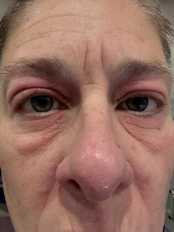 Swollen red and painful