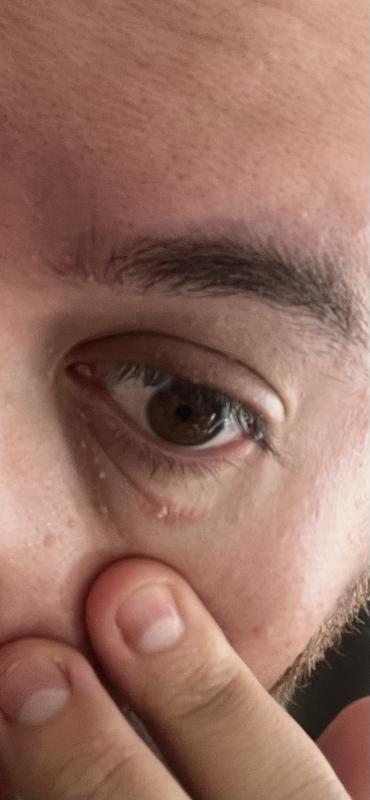 Irritated the skin under my eye after a few weeks of use.