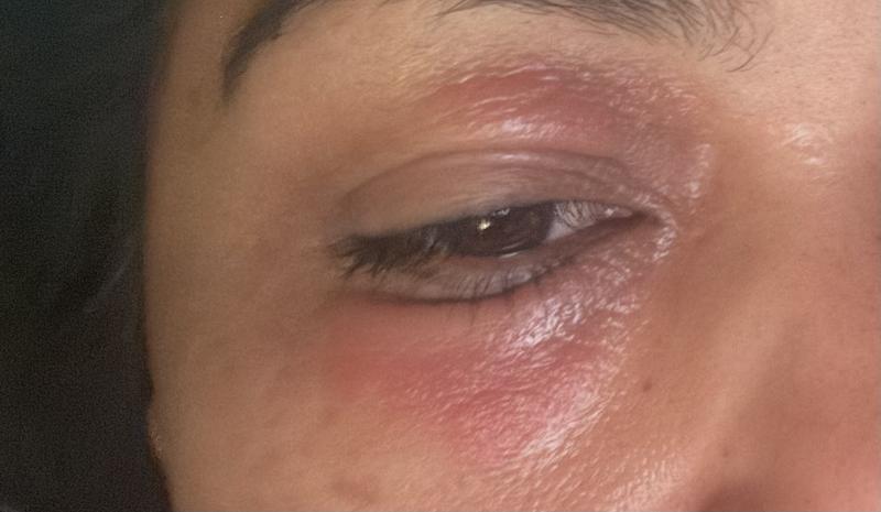 Red and swollen and burning