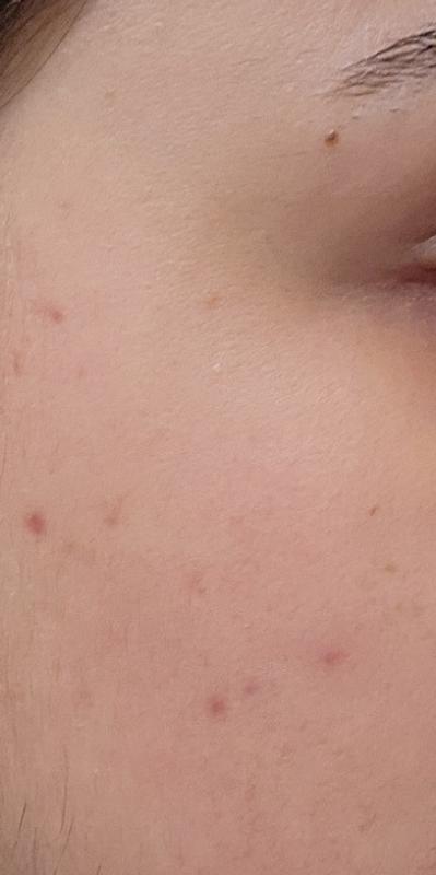 Just the acne spot left not the acne thanks God. I'm so happy. I just want to find a good product to help with these spot. Thanks kiehls.