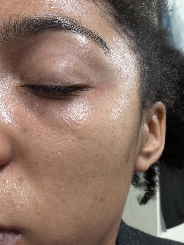 This is 24 hours after stopping use. I have never had puffy under eyes or wrinkles under my eyes before.