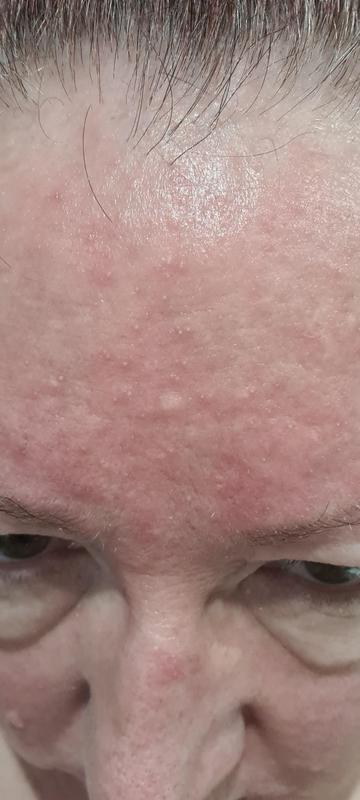 Bad rash reaction