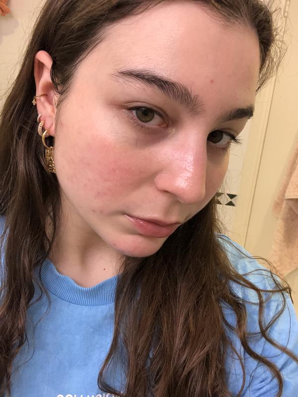 I have rosacea type skin and the oil helps to reduce redness and calm my skin.