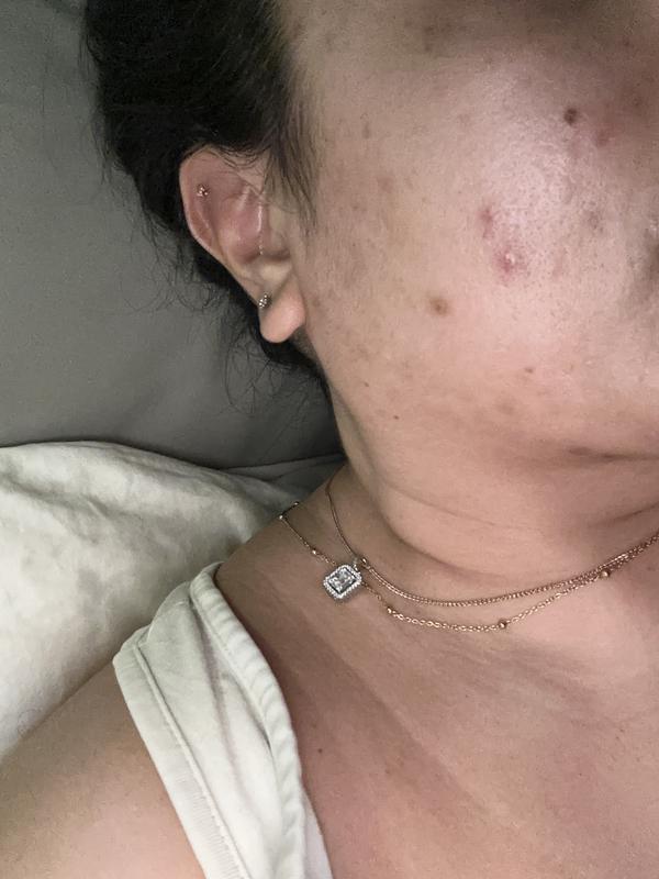Red blotchy skin