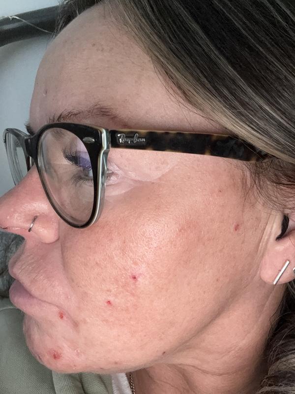 Dry itchy broken skin
