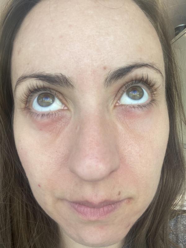 Under eye reaction