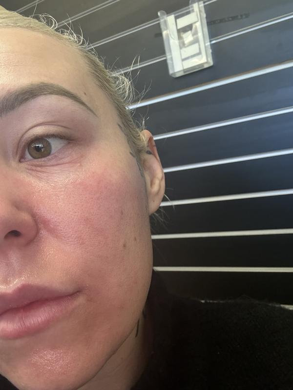 Burnt, swollen and red!!