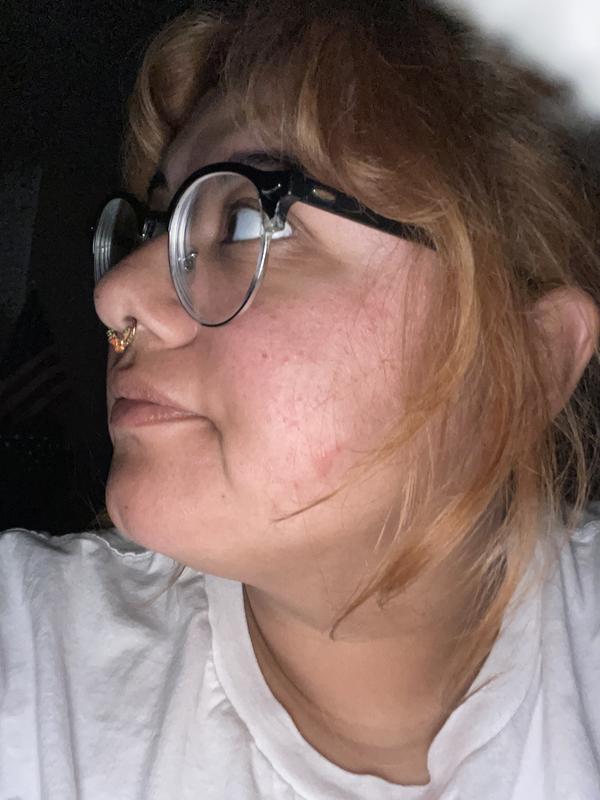 My skin while using Kylie Skin ✨