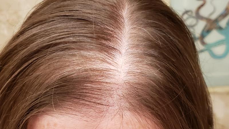 The day that I started using the HairMax LaserBand