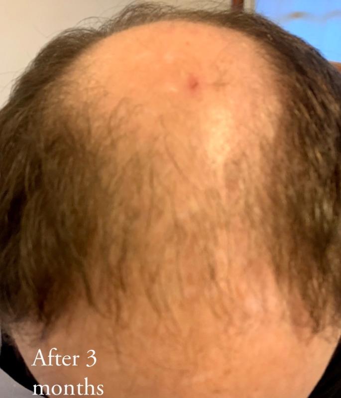 His hair is starting to fill in bold spots