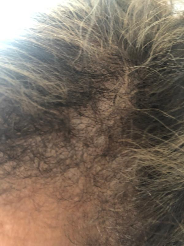 My natural part. Thin from medication