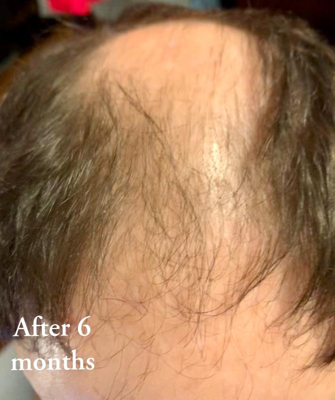 He has a significant amount of hair growing.